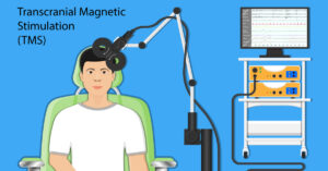animated graphic of TMS therapy